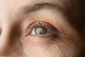 Exames periódicos de glaucoma podem evitar a cegueira