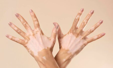 Vitiligo: uma condição de pele com impactos que vão além do físico