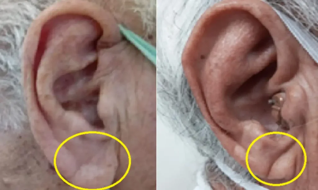 Estudo da FMABC identifica perfil mais comum do "sinal de Frank" e relativiza associação direta com infarto